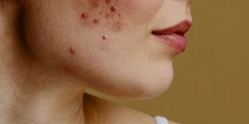 the battle against acne
